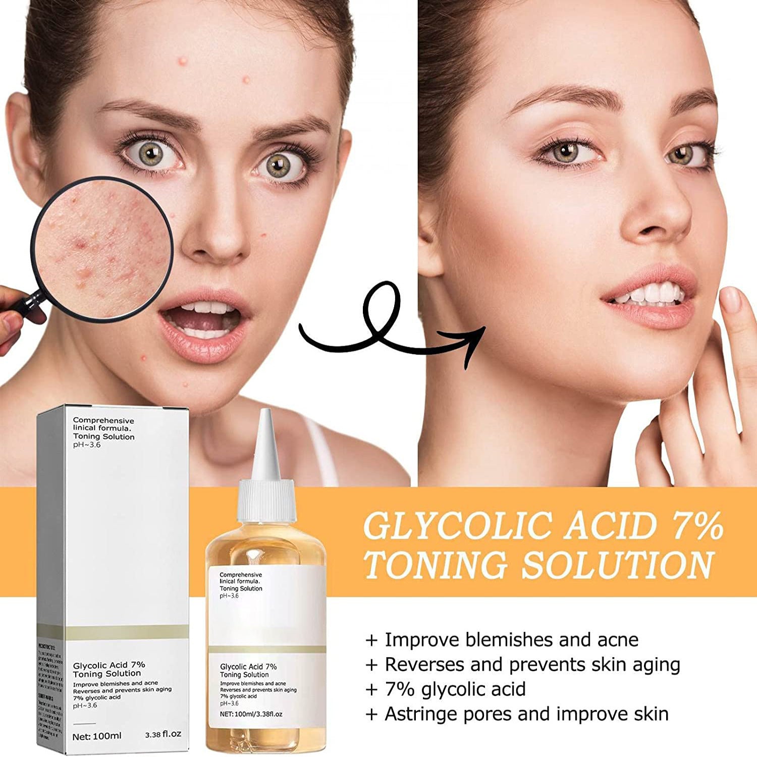 Anti-closed Acne Skin Moisturizing